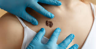Mole Removal Cosmetic Benefits Explained